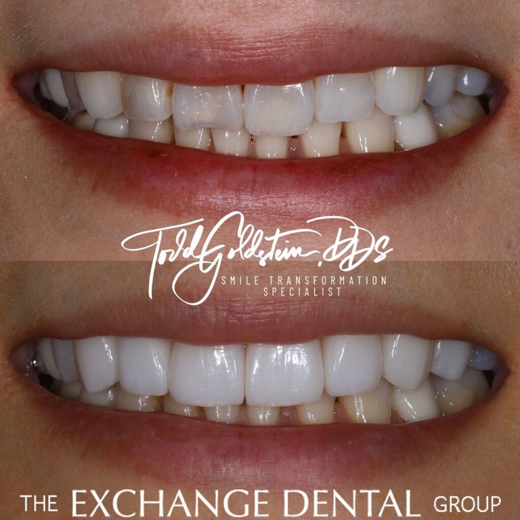Dental veneers patient before and after photo in New York City