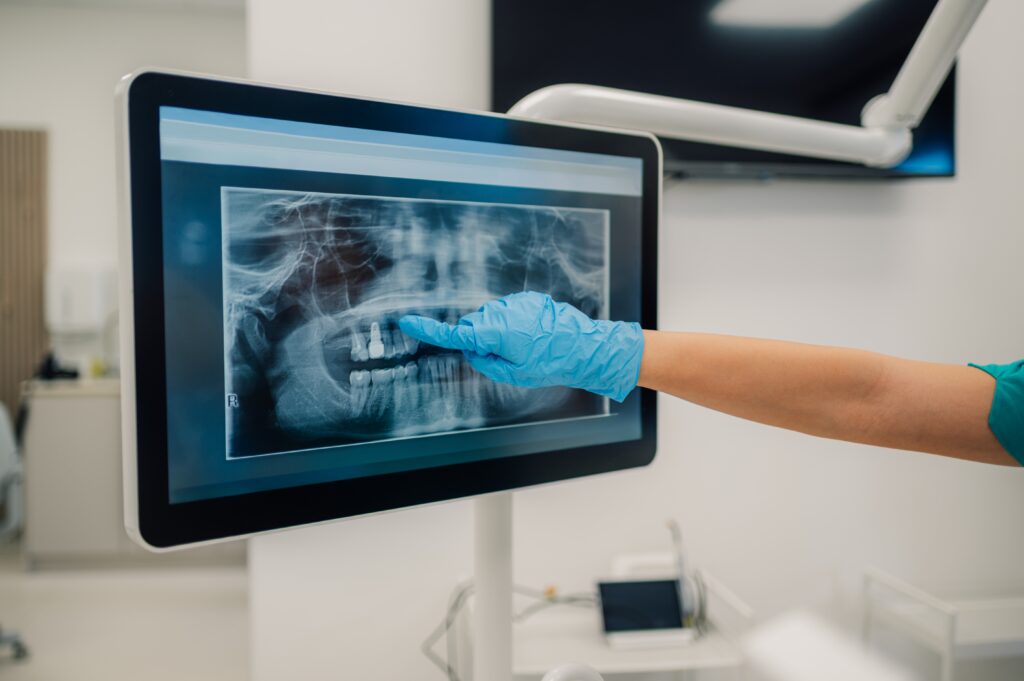 doctor pointing to an x-ray, showing the need for endodontic care